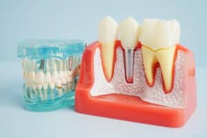 dental implants Marysville
